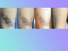 Лазерное удаление татуажа/татуировок объявление продам